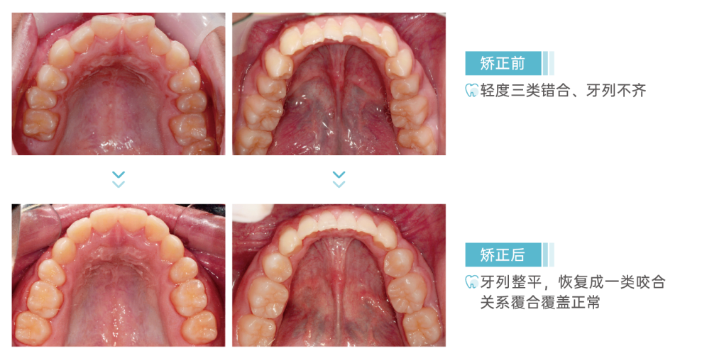 牙齿矫正技术